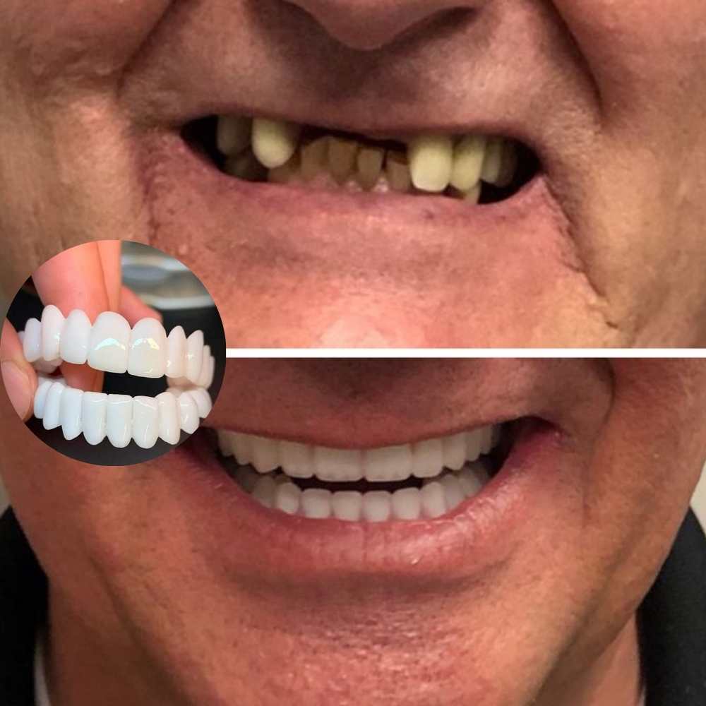 KIT COM 2 Placas Dentais de Cerâmica Removiveis Brancas – PARA TODAS ARCARIAS – Volte a ter um sorriso lindo como antes