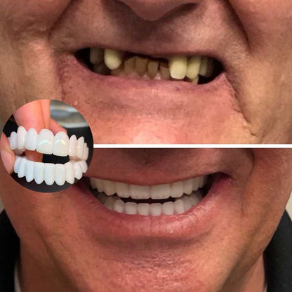 KIT COM 2 Placas Dentais de Cerâmica Removiveis Brancas – PARA TODAS ARCARIAS – Volte a ter um sorriso lindo como antes